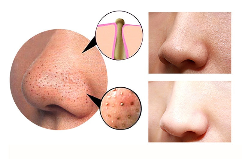 4-in-1 Body Guasha Cupping Blackhead Remover Machine Facial Pore Deep